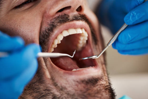 Best Knocked-Out Tooth (Avulsed Tooth) Treatment in Brookdale, NJ